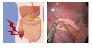 Cirurgia de Apendicite em Cascavel - PR