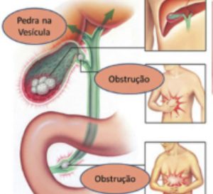 Cirurgia de vesícula em Cascavel - PR