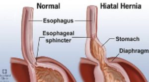 Tratamento Hernia de Hiato (hiatal) em Cascavel