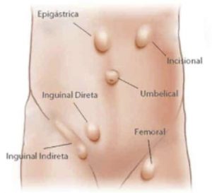 Hérnias da parede abdominal